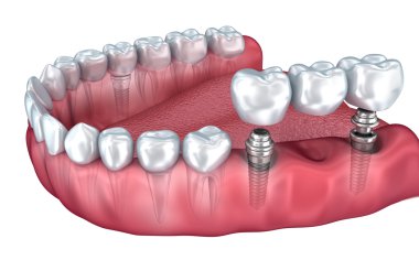 Alt dişler ve diş implantı şeffaf izole üzerinde beyaz render. 3D çizim