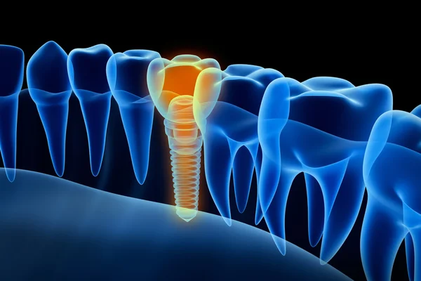 Vista a raggi X della protesi con impianto. Vista a raggi X. Illustrazione 3D clinicamente accurata — Foto Stock