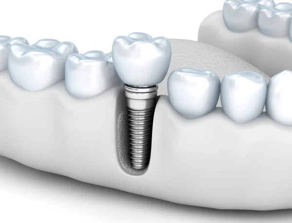 Implante humano dentário, ilustração 3D medicamente precisa estilo branco — Fotografia de Stock