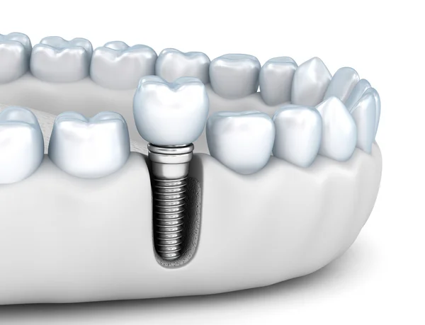 Tooth menselijke implantaat, medisch nauwkeurige 3d illustratie wit stijl — Stockfoto