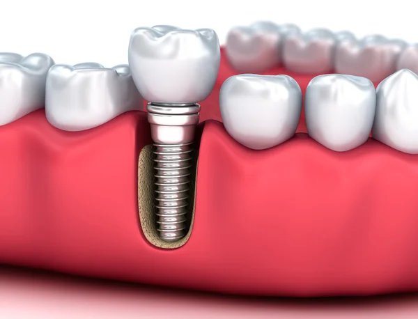 Implante humano dental, Ilustración 3D médicamente precisa estilo blanco — Foto de Stock