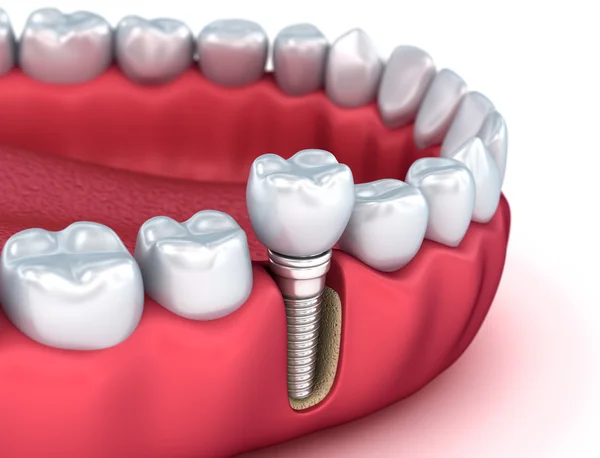 Diş insan implant, tıbben doğru 3d resimde beyaz stili — Stok fotoğraf