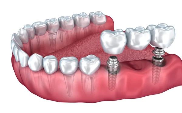 Alt dişler ve diş implantı şeffaf izole üzerinde beyaz render. 3D çizim — Stok fotoğraf