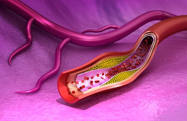 Tablica cholesterolu w naczynie krwionośne, medycznie dokładne ilustracja 3d — Zdjęcie stockowe