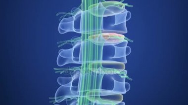 Spinal kord şişkin disk, x-ışını görünümü baskısı altında. 3D çizim