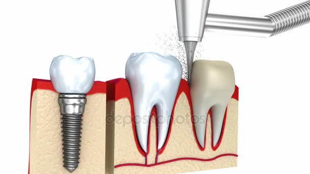 Processo di installazione corona dentale, isolato su bianco — Video Stock