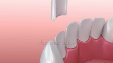 Diş kaplama: Porselen kaplama yükleme yordamı. 3D animasyon