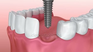 Diş implantı yükleme işlemi, tıbben doğru 3d animasyon