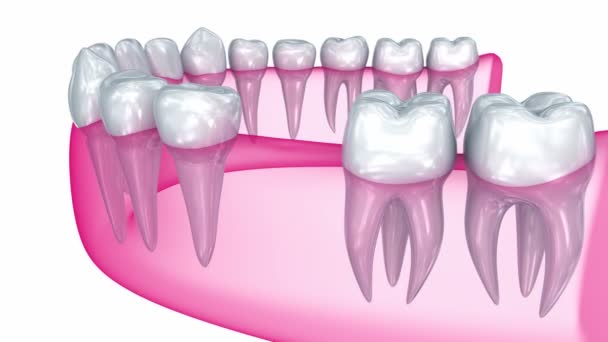 Installazione di impianti dentali, Animazione 3D Medicamente accurata — Video Stock