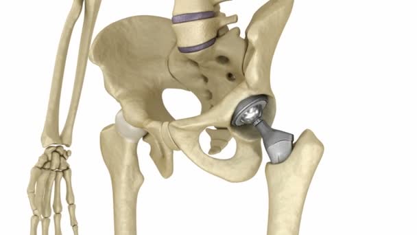 Heupprothese implantaat in het bot van het bekken geïnstalleerd. Medisch nauwkeurige 3D-animatie — Stockvideo