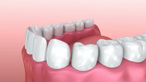 Goma de mascar y dientes. Animación 3D de dientes médicamente precisa . — Vídeos de Stock