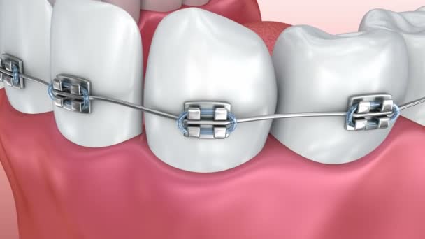 Zähne mit Zahnspangen isoliert auf weiß. medizinisch korrekte 3D-Animation.