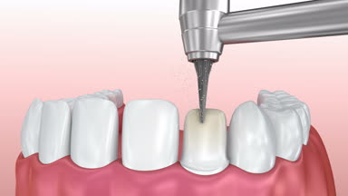 Diş kaplama: Porselen kaplama yükleme yordamı. 3D animasyon