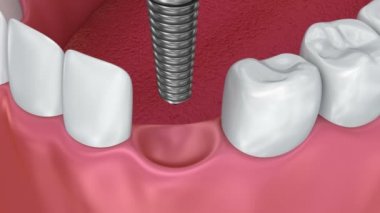 Diş implantı yükleme işlemi, tıbben doğru 3d animasyon