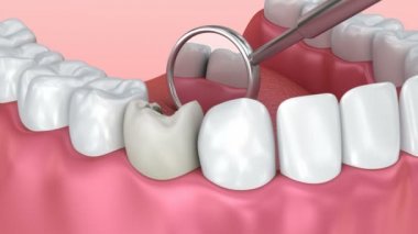 Diş çürüğü Muayene ile. Tıbben doğru diş 3d animasyon.