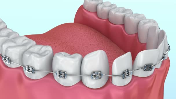 Dientes Con Frenos Proceso Alineación Animación Médicamente Precisa — Vídeo de stock