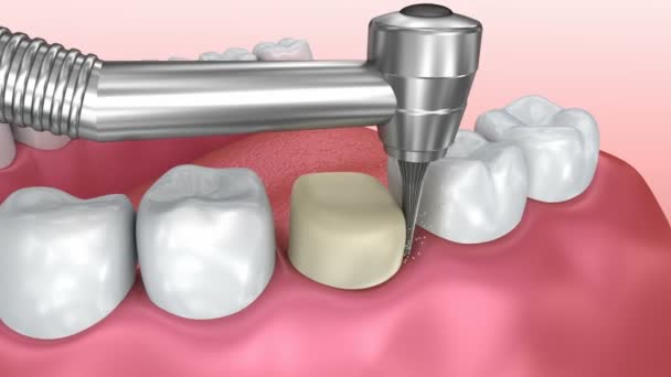 歯科クラウンのインストール プロセスでは 医学的に正確な アニメーション — ストック動画