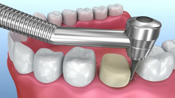 Processo Installazione Corona Dentale Animazione Medicamente Accurata — Video Stock