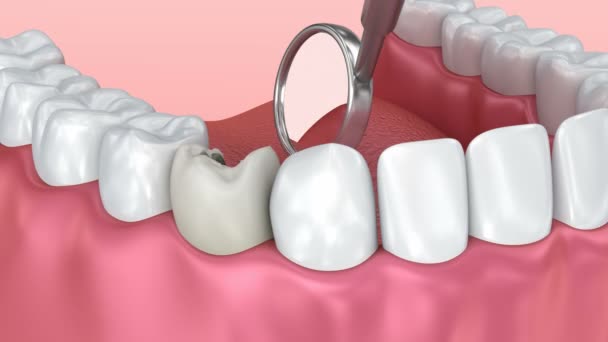 Ząb Próchnicy Inspekcji Animacja Medycznie Zęba — Wideo stockowe