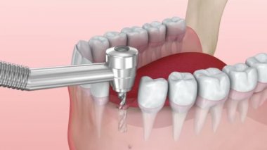 Diş implantı yükleme işlemi, tıbben doğru 3d animasyon