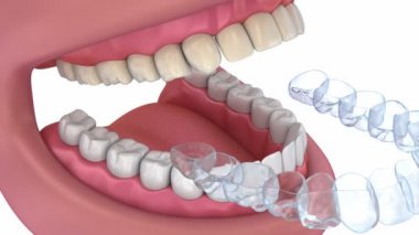 Diş beyazlatma işlemi. Tıbben doğru diş 3d animasyon.