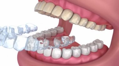 Diş beyazlatma işlemi. Tıbben doğru diş 3d animasyon.