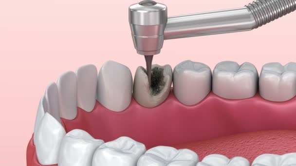 Dentes Com Cárie Tratamento Animação Dente Medicamente Precisa — Vídeo de Stock