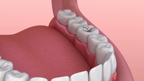 Zahnfüllungen Aus Metall Medizinisch Korrekte Animation — Stockvideo