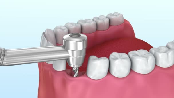 Процес Встановлення Зубних Імплантатів Медично Точна Анімація — стокове відео