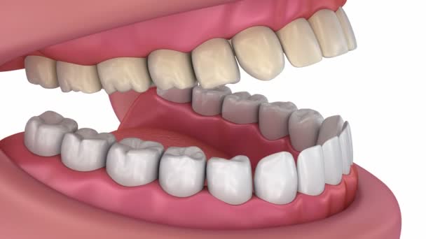 Bělení zubů proces. Lékařsky přesná zub 3d animace.