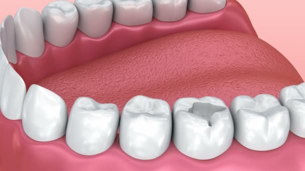 セラミック歯の詰め物 医学的に正確な アニメーション — ストック動画