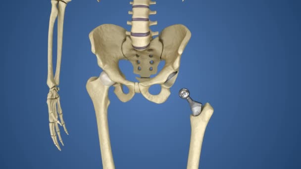 Implante Reemplazo Cadera Instalado Hueso Pelvis Animación Médicamente Precisa — Vídeo de stock