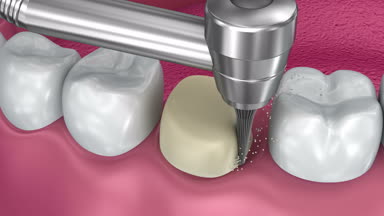 Diş crown yükleme işlemi, tıbben doğru 3d animasyon