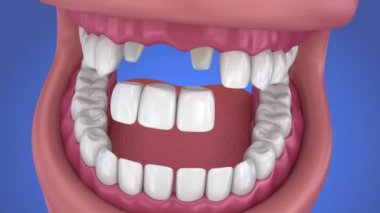 Desteklenen sabit köprü diş. Tıbben doğru 3d animasyon