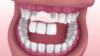 Ön diş sabit Köprülü desteklenen. Tıbben doğru 3d animasyon
