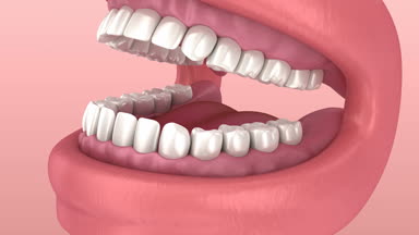 Yirmilik diş sorunu. Tıbben doğru diş 3d animasyon