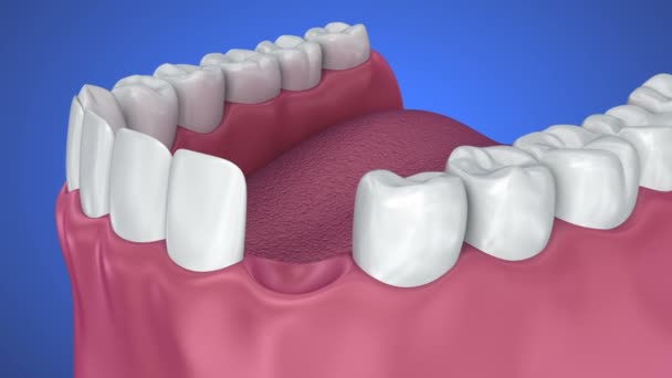 Processo Installazione Impianti Dentali Corona Animazione Clinicamente Accurata — Video Stock