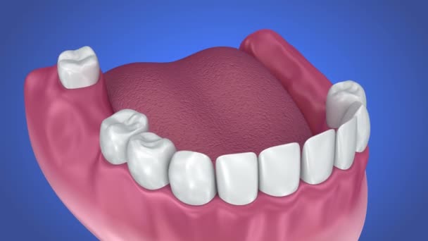 Diente soportado puente fijo. Médicamente preciso. animación 3d — Vídeos de Stock