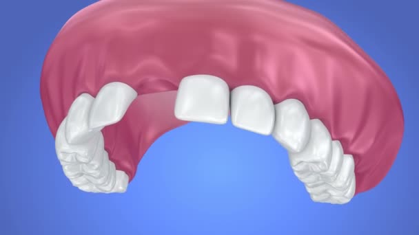 Diente faltante único: prótesis parcial extraíble. animación 3d — Vídeo de stock