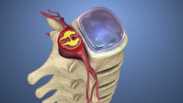 Spinal cord under pressure of bulging disc, 3d animation — Stock Video