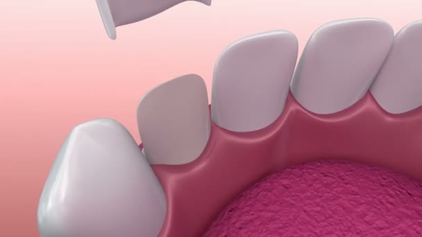 Chapas dentales: procedimiento de instalación de chapa de porcelana. Animación 3D — Vídeo de stock