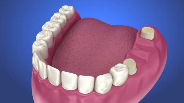 Dente supportato processo di installazione ponte fisso. Animazione 3D clinicamente accurata — Video Stock