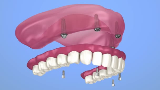 Prothese, die auf Implantaten sitzt - Kugelbefestigungen, Installationsprozess. 3D-Animation — Stockvideo