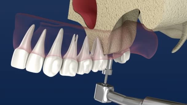 Cirurgia de elevação sinusal - Aumento sinusal. Animação 3D . — Vídeo de Stock