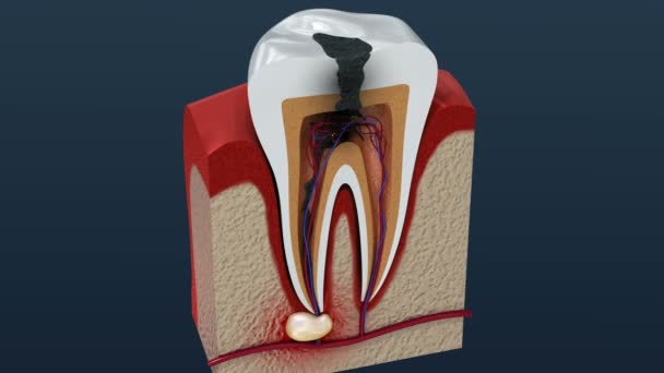 Root canal treatment process. 3D Animation. — Stock Video © Alexmit  #194189004