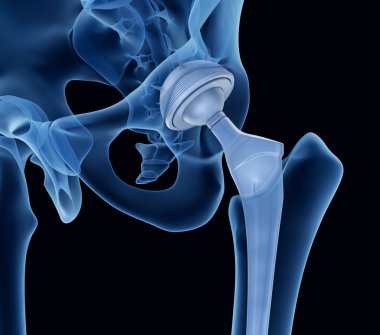 Kalça protezi implant leğen kemiği yüklü. X-ışını görünümü. Tıbben doğru 3d çizim 