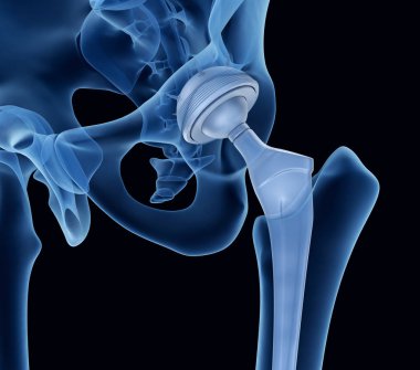 Hip replacement implant installed in the pelvis bone. X-ray view. Medically accurate 3D illustration  clipart