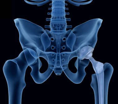 Hip replacement implant installed in the pelvis bone. X-ray view. Medically accurate 3D illustration  clipart