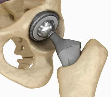 Kalça protezi implant leğen kemiği yüklü. Tıbben doğru 3d çizim 