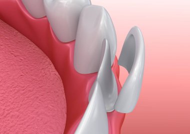 Diş kaplama: Porselen kaplama yükleme yordamı. 3D çizim